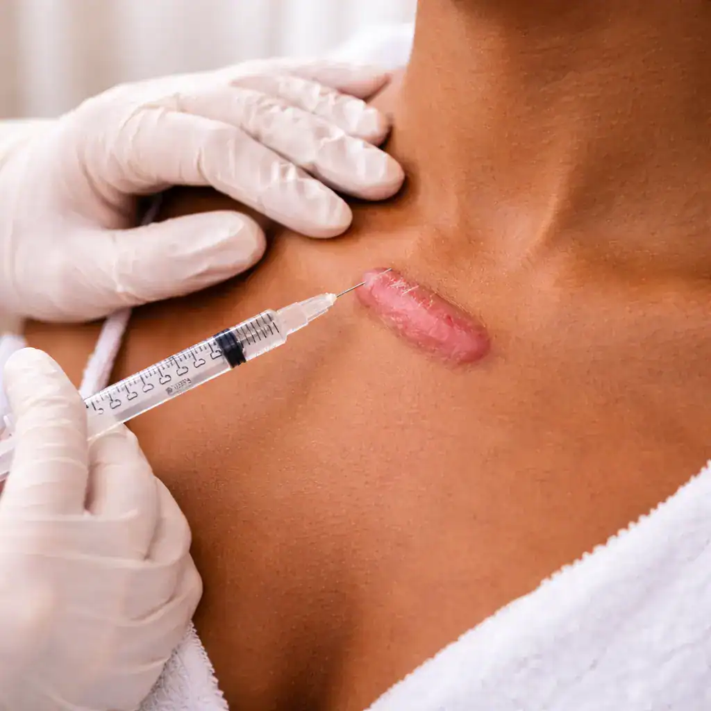 Gloved hands giving a corticosteroid injection into a raised keloid scar below the collarbone