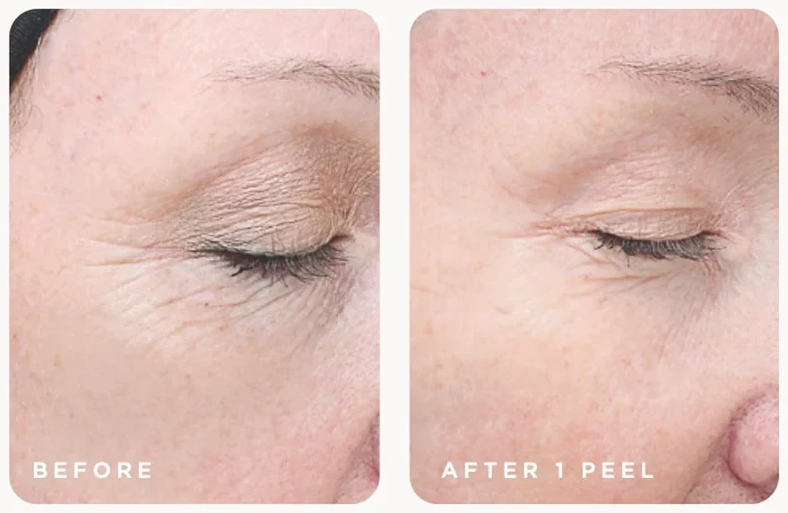 VI Peel before and after, fine lines around the eye after one Advanced peel, photo courtesy of VI Aesthetics