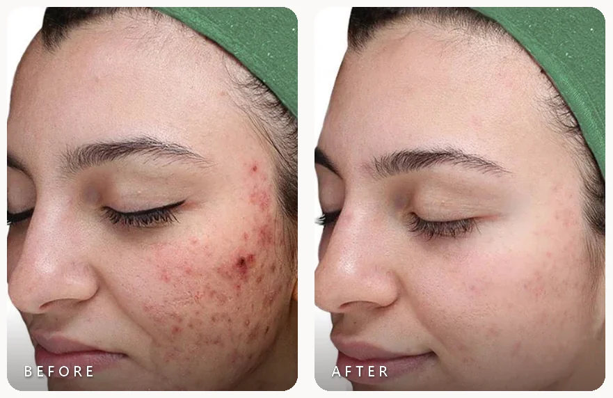 VI Peel before and after, active acne clearing after treatment, photo courtesy of VI Aesthetics