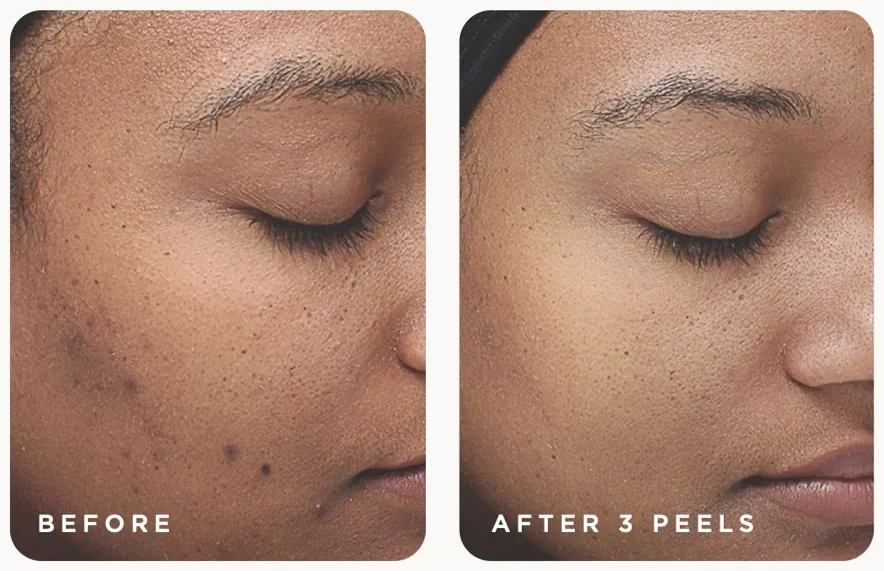 VI Peel before and after, dark spots and uneven tone on deeper skin after three Original peels, photo courtesy of VI Aesthetics