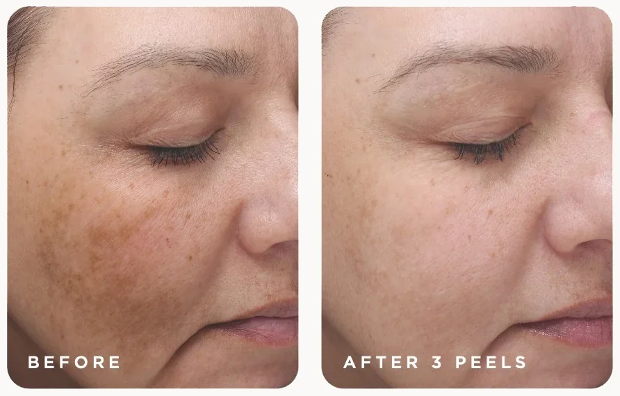 VI Peel before and after, melasma and sun spots after three Precision Plus with Peptides peels, photo courtesy of VI Aesthetics