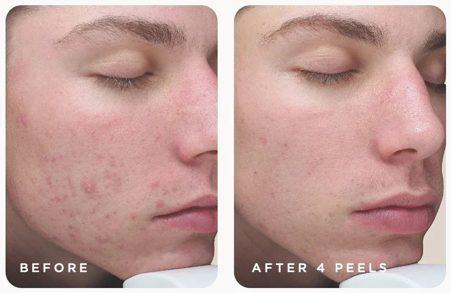 VI Peel before and after, active acne after four Purify peels, photo courtesy of VI Aesthetics
