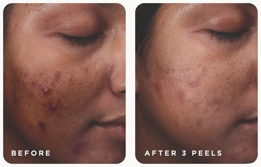 VI Peel before and after, active acne and dark acne marks after three Purify with Precision Plus peels, photo courtesy of VI Aesthetics